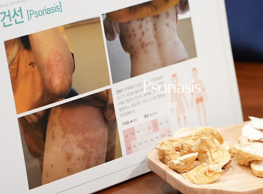 생기한의원이 설명하는 건선 원인 유전 및 환경 요인 정리