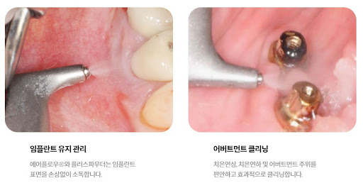 불당본점 서울비디치과의원에서 제공하는 천안 임플란트와 치아교정의 원스톱 서비스